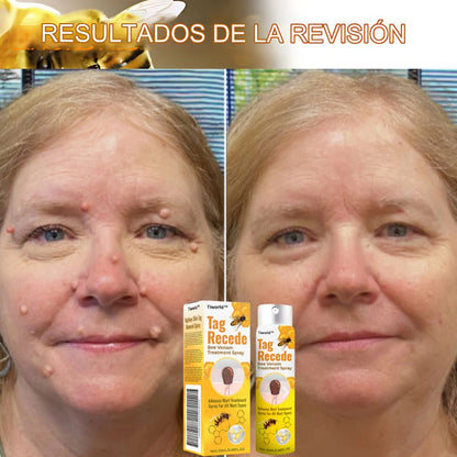 Crema Para Eliminar Verrugas