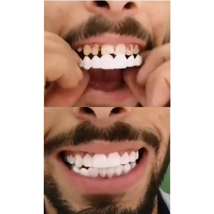 Carillas Dentales Removibles