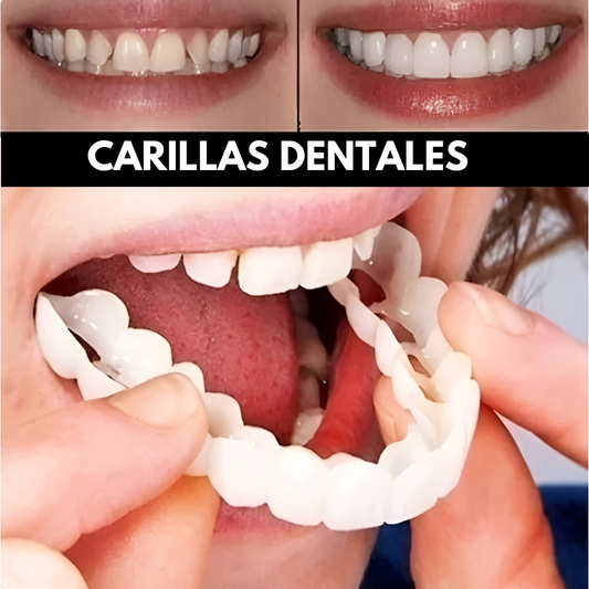 Carillas Dentales Removibles